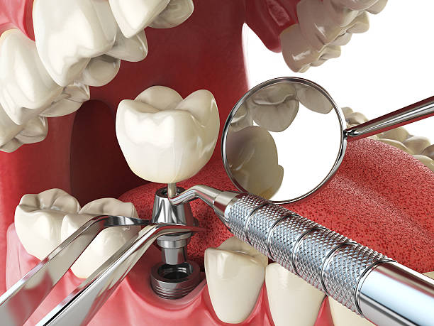 Best Emergency Dental Extractions in Claremore, OK